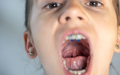 News & Congressi 7 Tonsilliti nel bambino: quando le “sentinelle” della gola si ammalano
